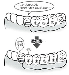 従来の入れ歯と最も違う点は、歯を守る入れ歯