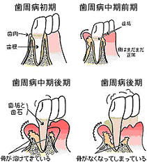 歯周病は痛みが無く進行する