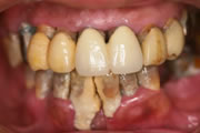 最新の歯周病治療『歯周内科治療』