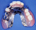 チタン床義歯 