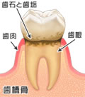 歯肉炎