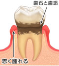 歯周炎とは・・・ 